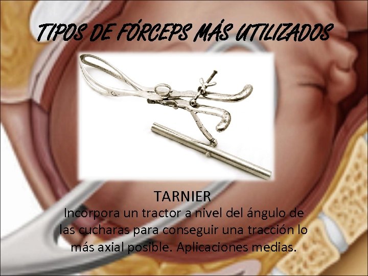 TIPOS DE FÓRCEPS MÁS UTILIZADOS TARNIER Incorpora un tractor a nivel del ángulo de