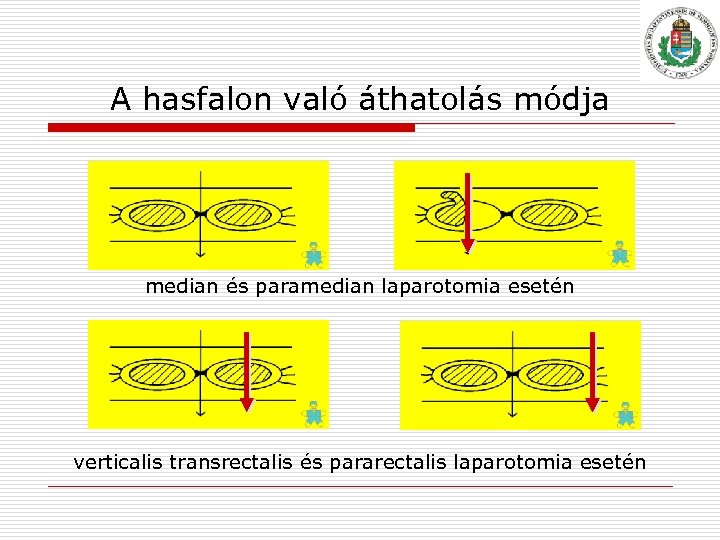 A hasfalon való áthatolás módja median és paramedian laparotomia esetén verticalis transrectalis és pararectalis