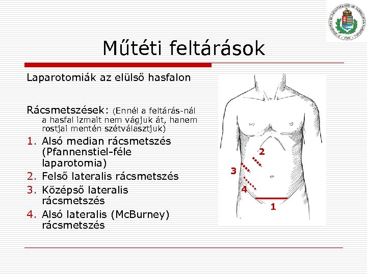 Műtéti feltárások Laparotomiák az elülső hasfalon Rácsmetszések: (Ennél a feltárás nál a hasfal izmait