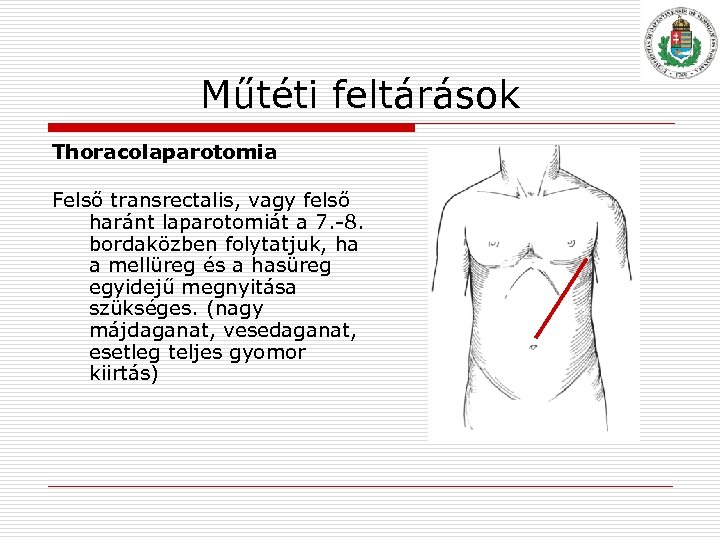 Műtéti feltárások Thoracolaparotomia Felső transrectalis, vagy felső haránt laparotomiát a 7. 8. bordaközben folytatjuk,