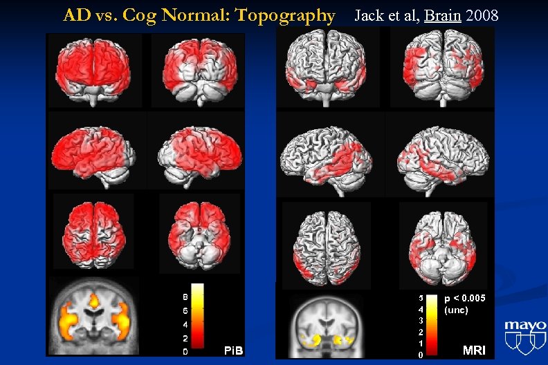 AD vs. Cog Normal: Topography Jack et al, Brain 2008 5 4 3 2