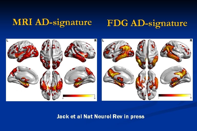 MRI AD-signature FDG AD-signature Jack et al Nat Neurol Rev in press 