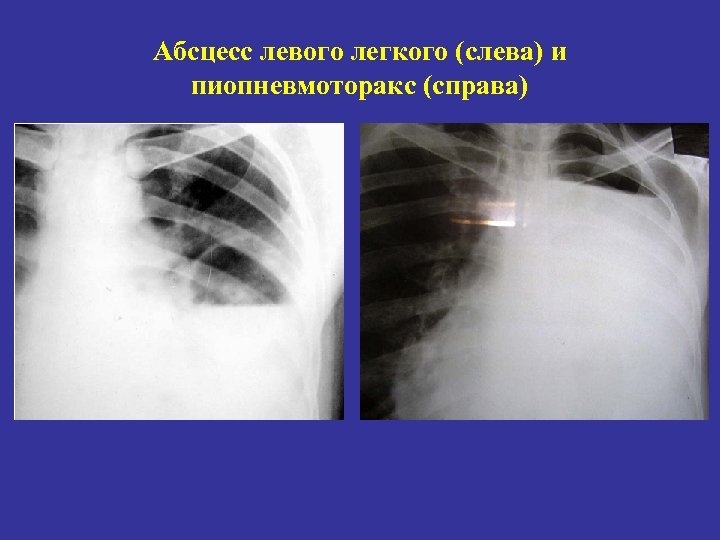 На рентгенологической картине напряженного пиопневмоторакса отмечается смещение средостения в