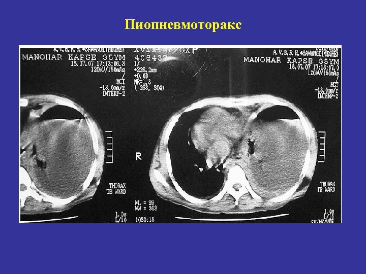 Пиопневмоторакс 