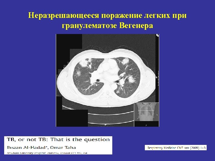 Неразрешающееся поражение легких при гранулематозе Вегенера 