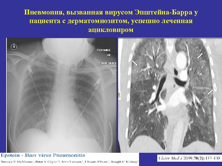 Пневмония, вызванная вирусом Эпштейна-Барра у пациента с дерматомиозитом, успешно леченная ацикловиром 