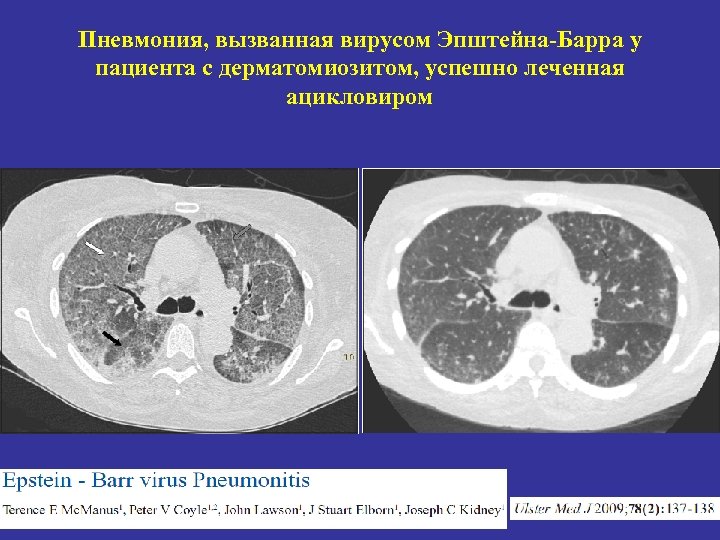 Пневмония, вызванная вирусом Эпштейна-Барра у пациента с дерматомиозитом, успешно леченная ацикловиром 