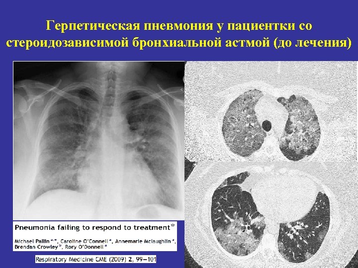 Герпетическая пневмония у пациентки со стероидозависимой бронхиальной астмой (до лечения) 