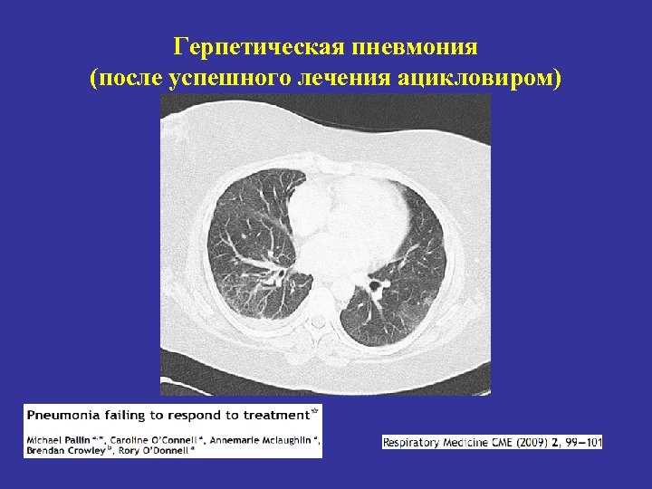 Герпетическая пневмония (после успешного лечения ацикловиром) 