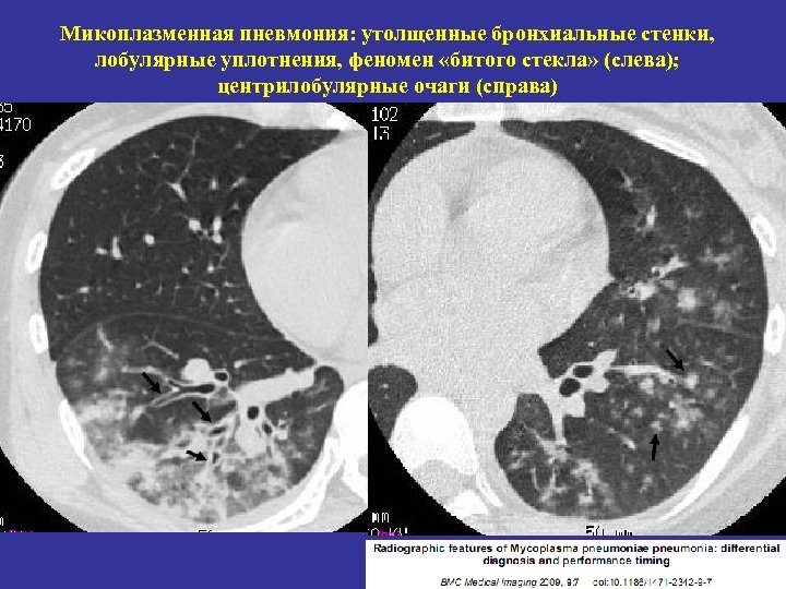 Пневмония на кт. Микоплазменная пневмония на кт легких. Микоплазменная пневмония на кт. Бронхопневмония пневмония на кт. Кт лобулярная пневмония.
