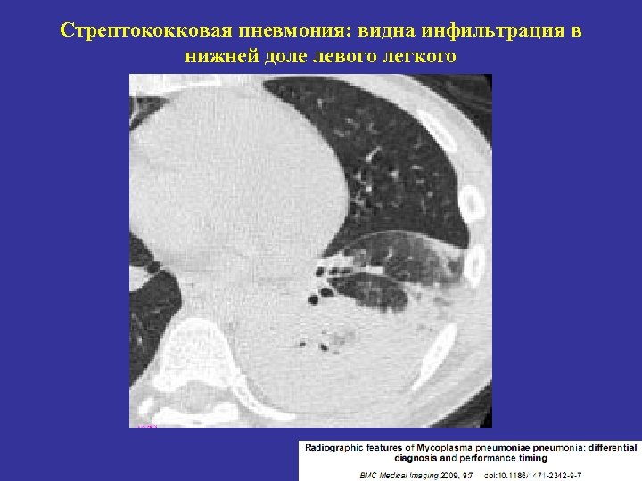 Видное пневмония. Стрептококковая пневмония кт. Стрептококковая пневмония рентгенограмма. Стрептококковая пневмония рентген. Очаговая стрептококковая пневмония.