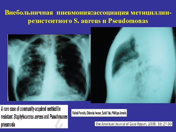 Внебольничная пневмония: ассоциация метициллинрезистентного S. aureus и Pseudomonas 