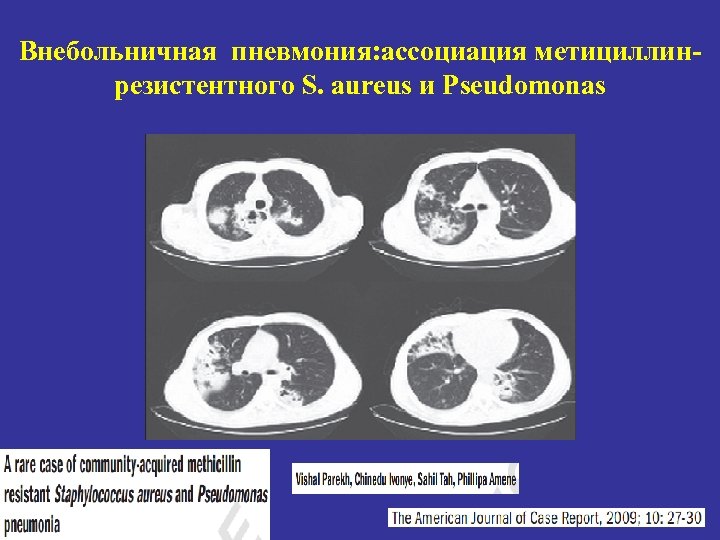 Внебольничная пневмония: ассоциация метициллинрезистентного S. aureus и Pseudomonas 