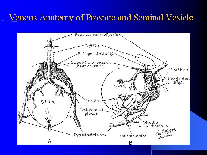 Venous Anatomy of Prostate and Seminal Vesicle 