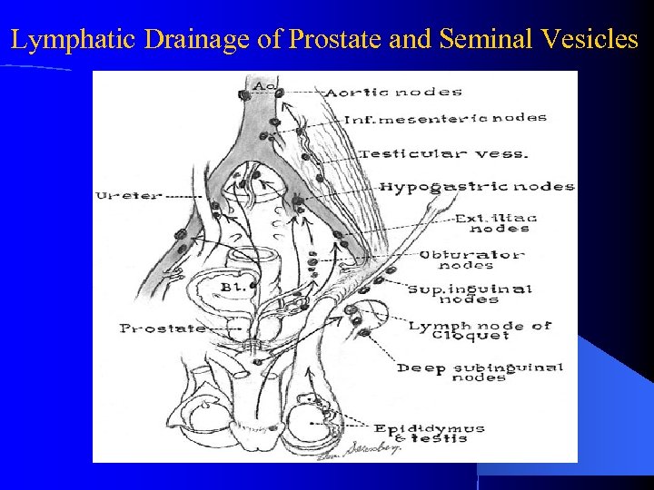 Lymphatic Drainage of Prostate and Seminal Vesicles 