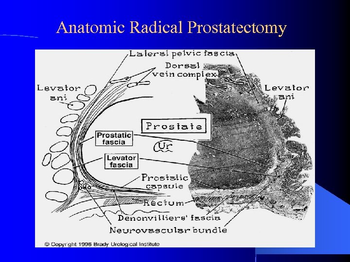 Anatomic Radical Prostatectomy 