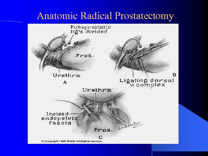 Anatomic Radical Prostatectomy 
