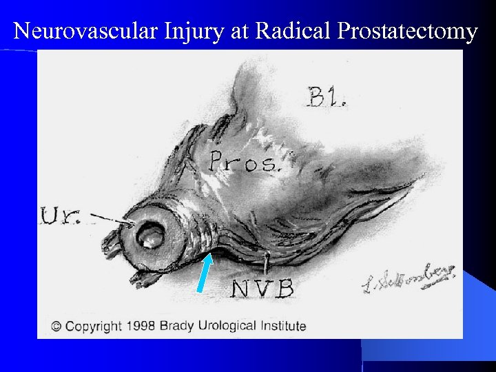Neurovascular Injury at Radical Prostatectomy 