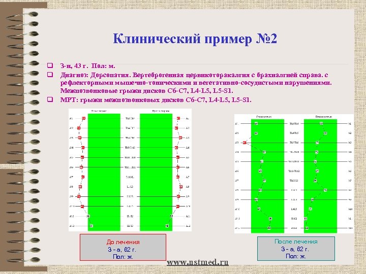 Клинический пример № 2 q З-н, 43 г. Пол: м. q Диагноз: Дорсопатия. Вертеброгенная