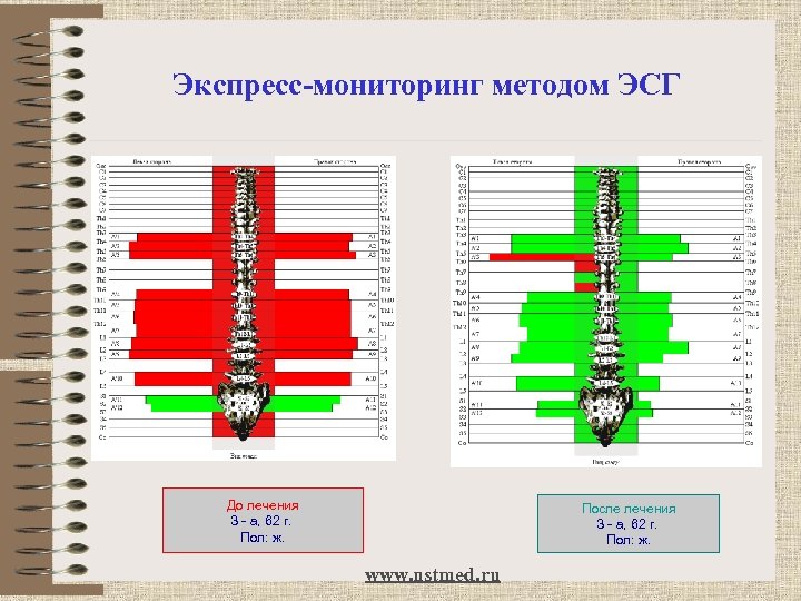 Экспресс-мониторинг методом ЭСГ До лечения З - а, 62 г. Пол: ж. После лечения