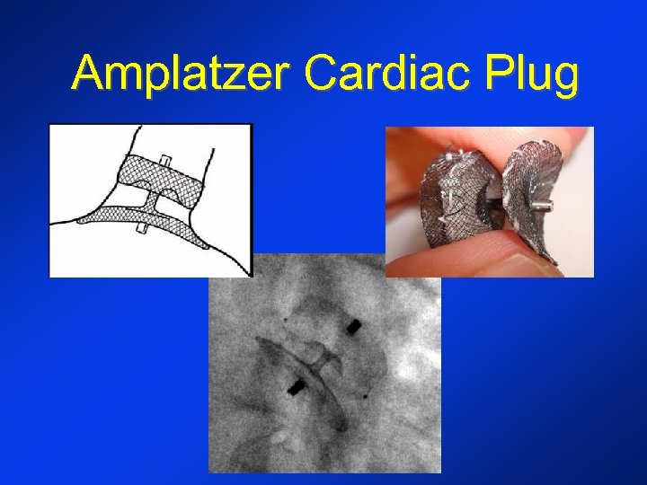 Amplatzer Cardiac Plug 