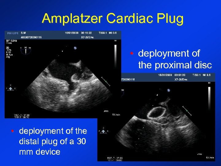 Amplatzer Cardiac Plug • deployment of the proximal disc • deployment of the distal