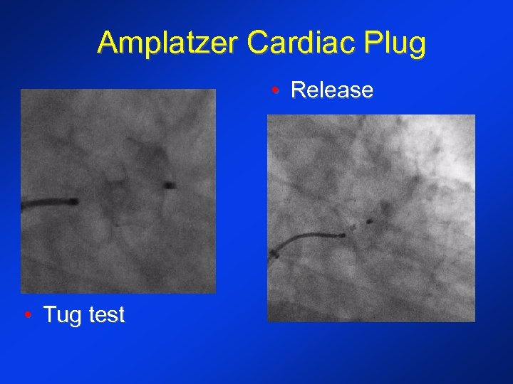 Amplatzer Cardiac Plug • Release • Tug test 