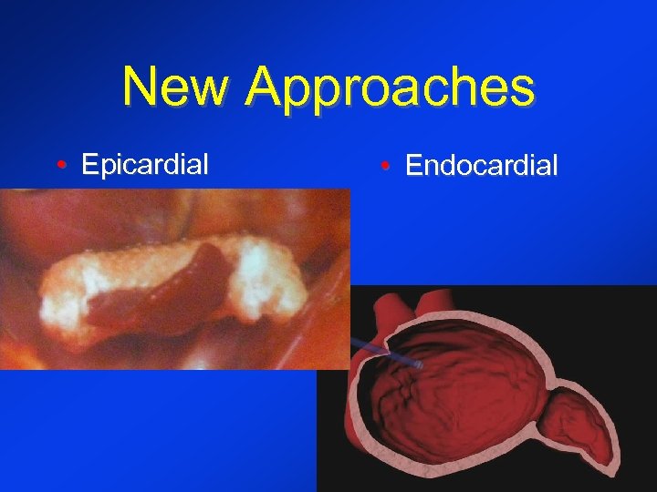 New Approaches • Epicardial • Endocardial 