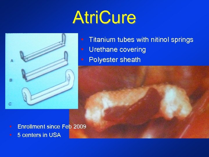 Atri. Cure • • Enrollment since Feb 2009 • 5 centers in USA Titanium
