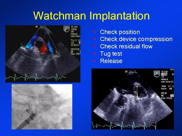 Watchman Implantation • • • Check position Check device compression Check residual flow Tug