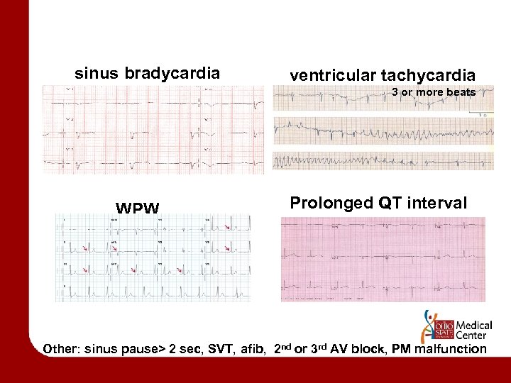 sinus bradycardia ventricular tachycardia 3 or more beats WPW Prolonged QT interval Other: sinus