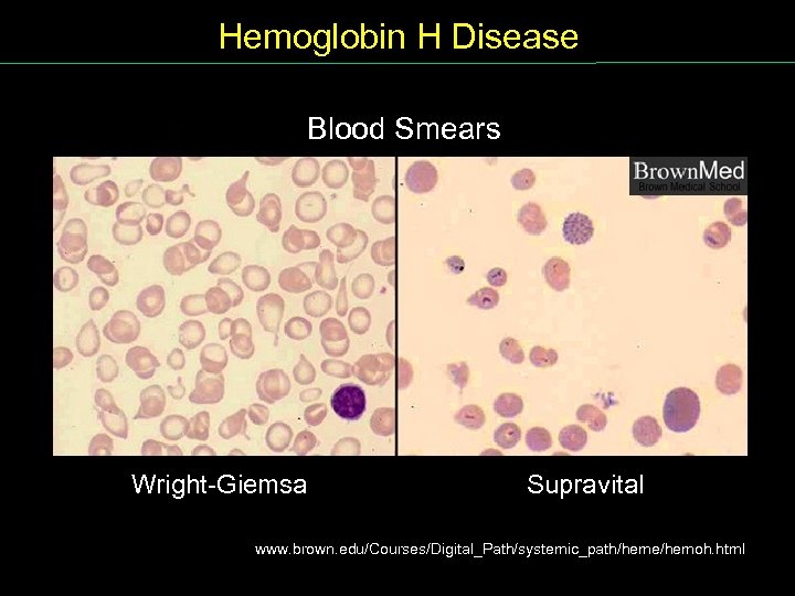 Hemoglobin H Disease Blood Smears Wright Giemsa Supravital www. brown. edu/Courses/Digital_Path/systemic_path/heme/hemoh. html 