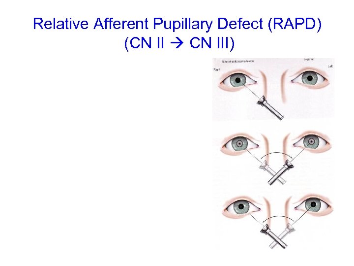 Relative Afferent Pupillary Defect (RAPD) (CN II CN III) 