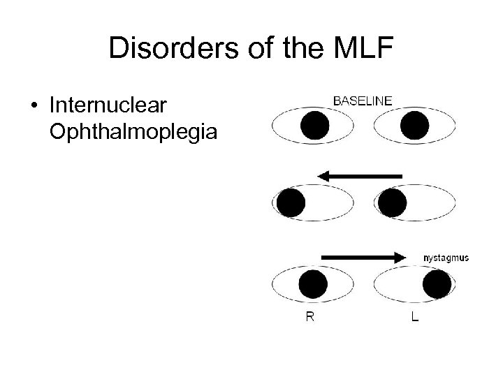 Disorders of the MLF • Internuclear Ophthalmoplegia 