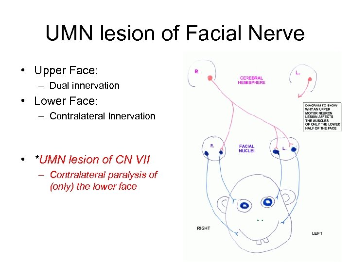 UMN lesion of Facial Nerve • Upper Face: – Dual innervation • Lower Face: