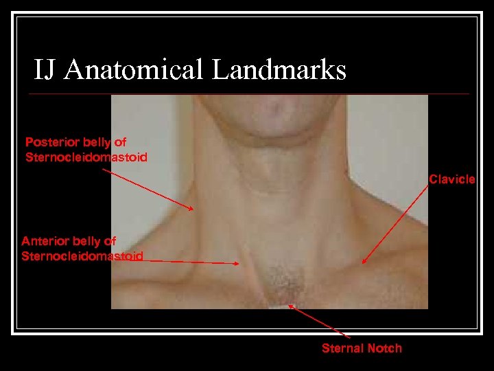 IJ Anatomical Landmarks Posterior belly of Sternocleidomastoid Clavicle Anterior belly of Sternocleidomastoid Sternal Notch