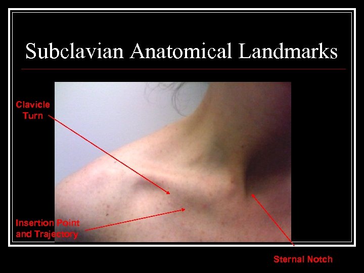 Subclavian Anatomical Landmarks Clavicle Turn Insertion Point and Trajectory Sternal Notch 