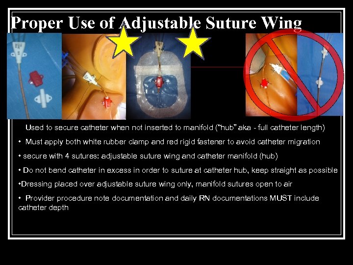 Proper Use of Adjustable Suture Wing • Used to secure catheter when not inserted