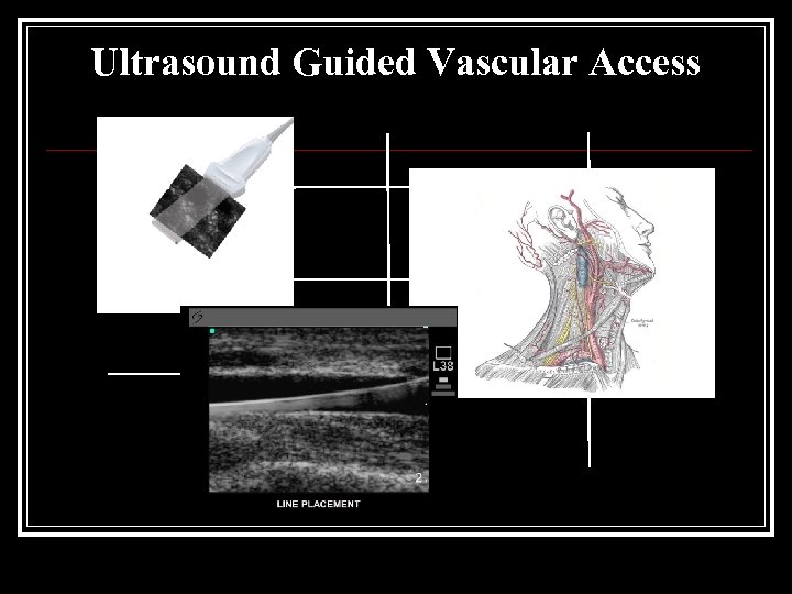 Ultrasound Guided Vascular Access 