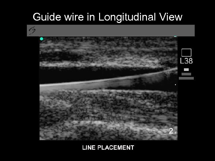 Guide wire in Longitudinal View 