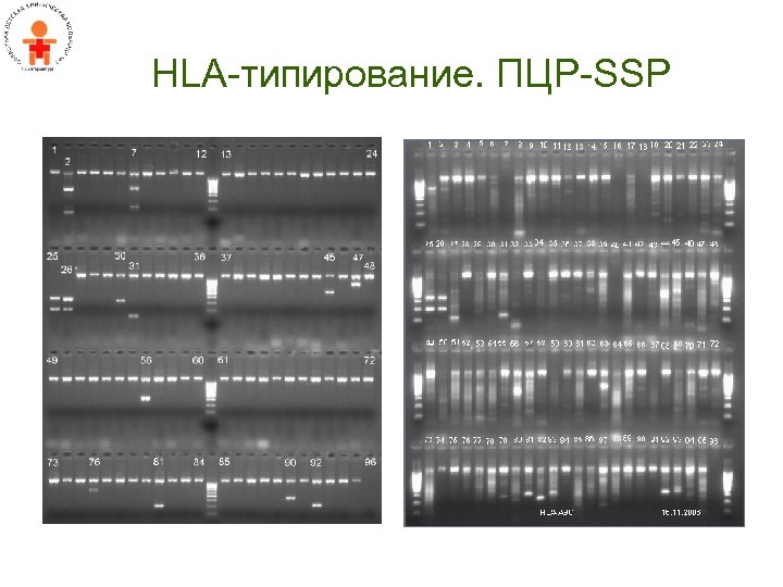 HLA-типирование. ПЦР-SSP 