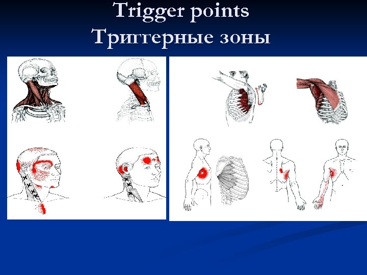 Trigger points Триггерные зоны 