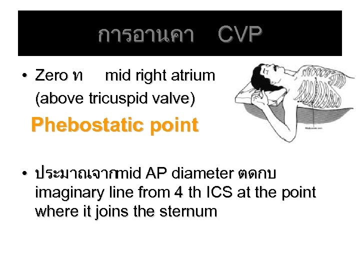 การอานคา CVP • Zero ท mid right atrium (above tricuspid valve) Phebostatic point •