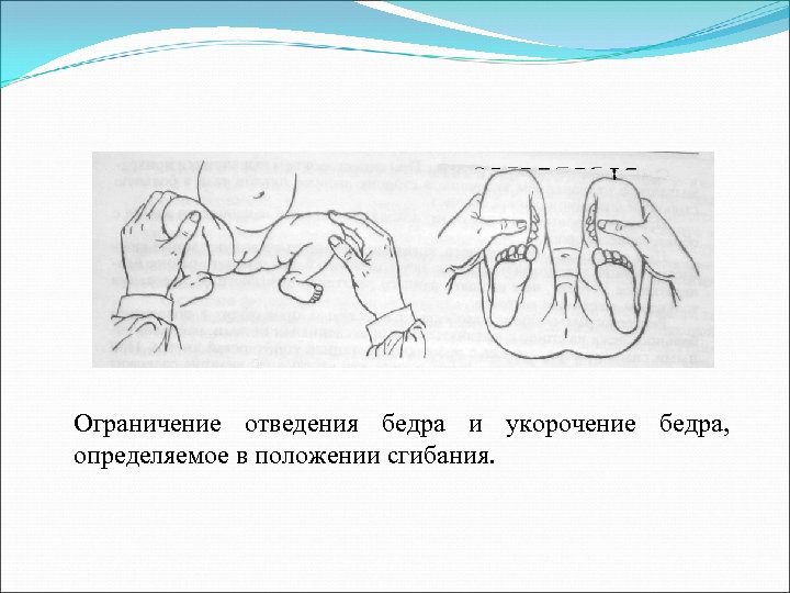 Ограничение отведения бедра и укорочение бедра, определяемое в положении сгибания. 