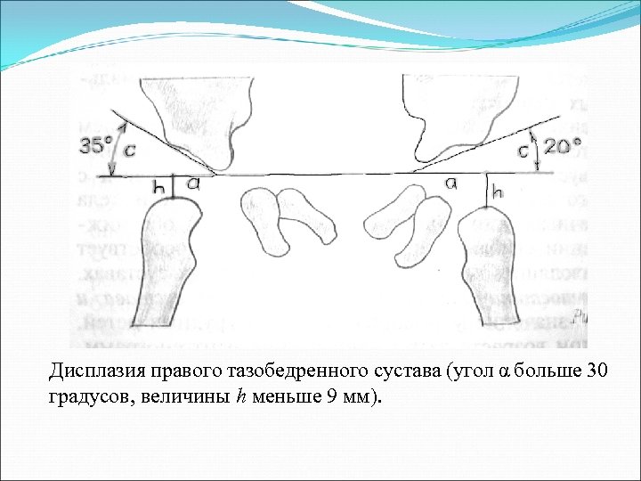 Схема врожденного вывиха бедра