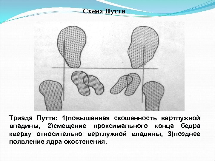 Схема врожденного вывиха бедра