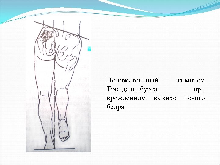 Положительный симптом Тренделенбурга при врожденном вывихе левого бедра 