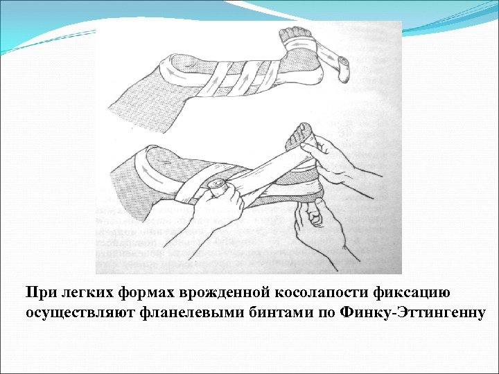 При легких формах врожденной косолапости фиксацию осуществляют фланелевыми бинтами по Финку-Эттингенну 