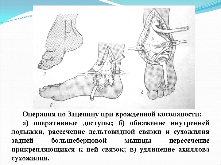 Операция по Зацепину при врожденной косолапости: а) оперативные доступы; б) обнажение внутренней лодыжки, рассечение