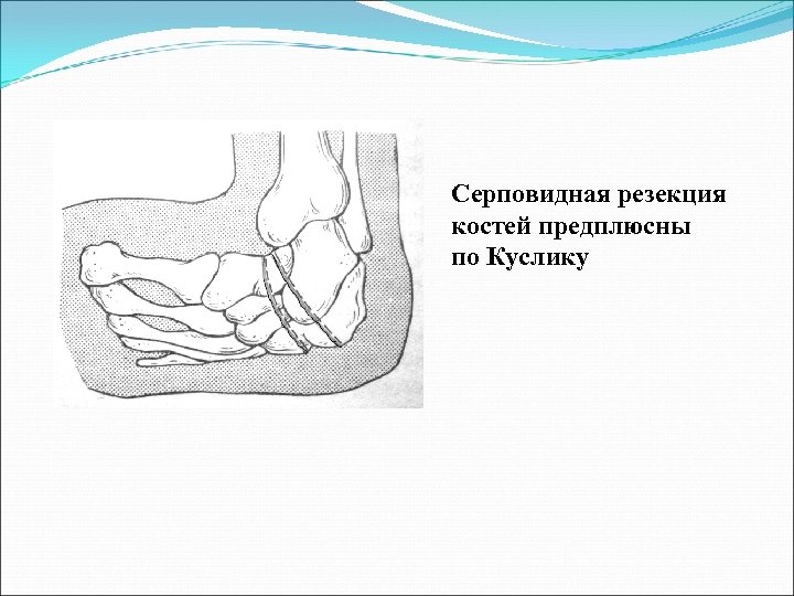 Серповидная резекция костей предплюсны по Куслику 